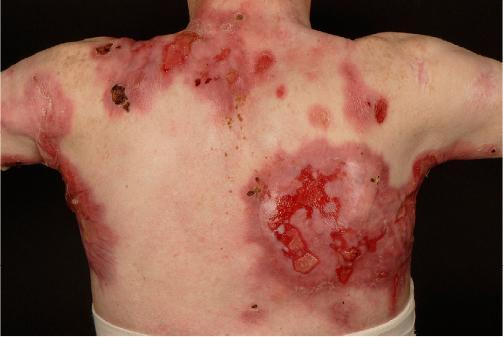 The back of a patient with defects in keratin.