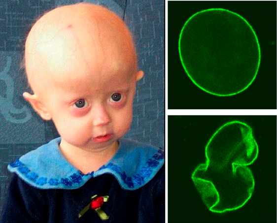 A patient with progeria, and a comparison between nuclear lamina in healthy and progeria patients.