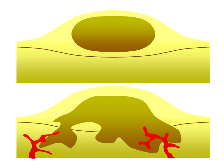 Benign and malignant tumours.